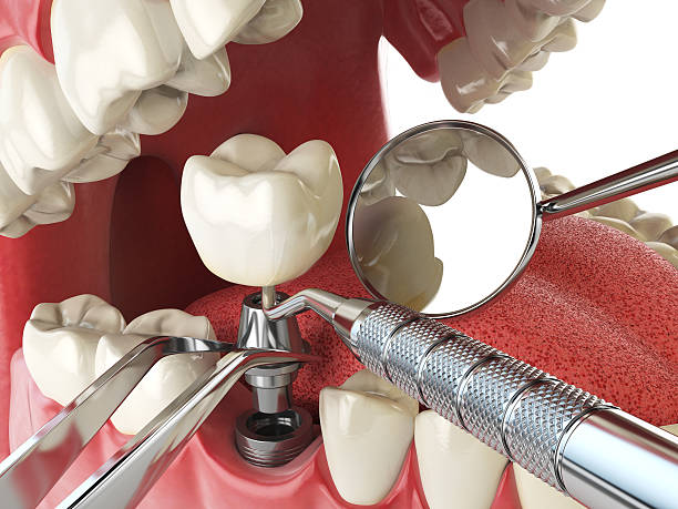 Best Knocked-Out Tooth (Avulsed Tooth) Treatment in North Newton, KS